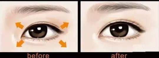 开内眼角应该如何避免留疤痕？