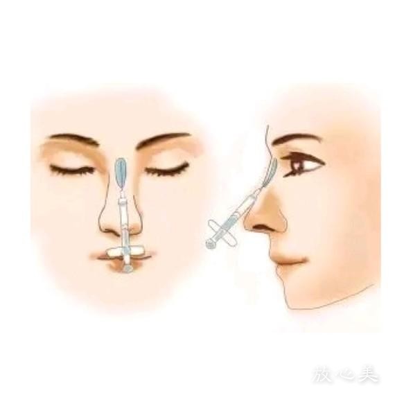 广州鼻小柱缺损修复贵吗？