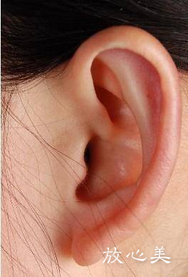 海南全耳再造术现在弄多少钱(全耳再造术手术方法哪个好)