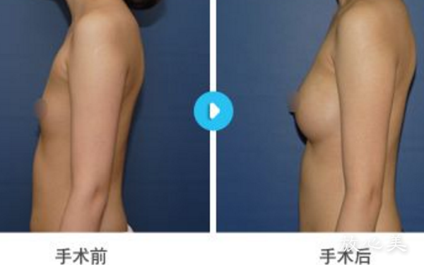 广东药学院附属第一医院激光整形美容外科是正规的吗？附收费价目表+隆胸案例~